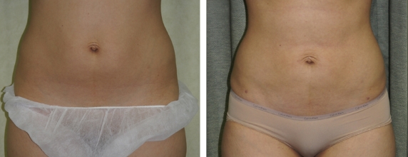 Lipo Before and After images