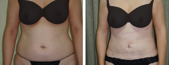 Laser Liposuction Before and after images